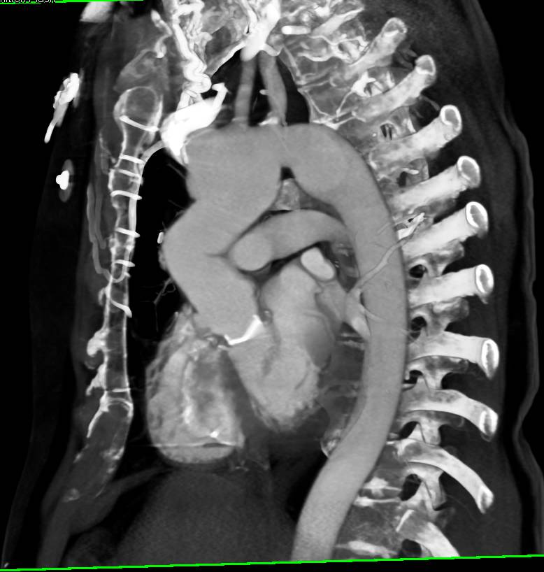 Aortic Valve Replacement (AVR) with Aortic Root Repair - CTisus CT Scan