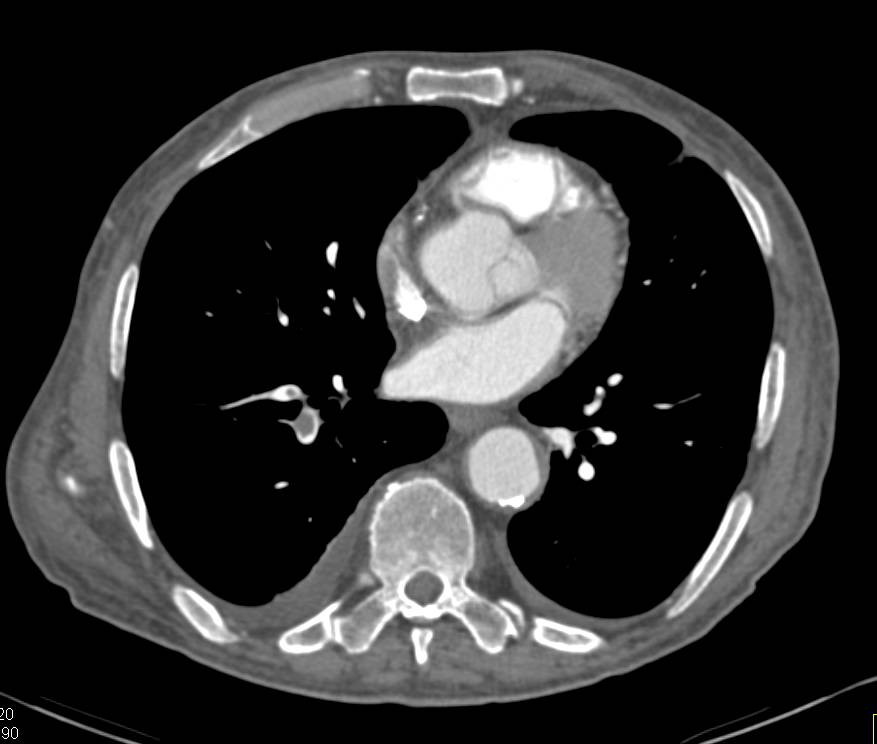 Pulmonary Embolism in a Patient with a Cystic Renal Cell Carcinoma - CTisus CT Scan