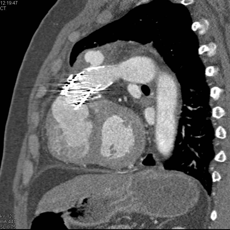 Pseudoaneurysm off Aortic Arch - CTisus CT Scan
