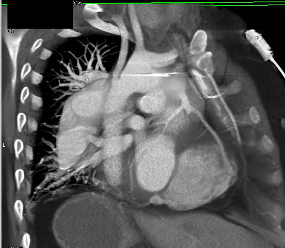 Complex Repair of Aortic Aneurysm - CTisus CT Scan