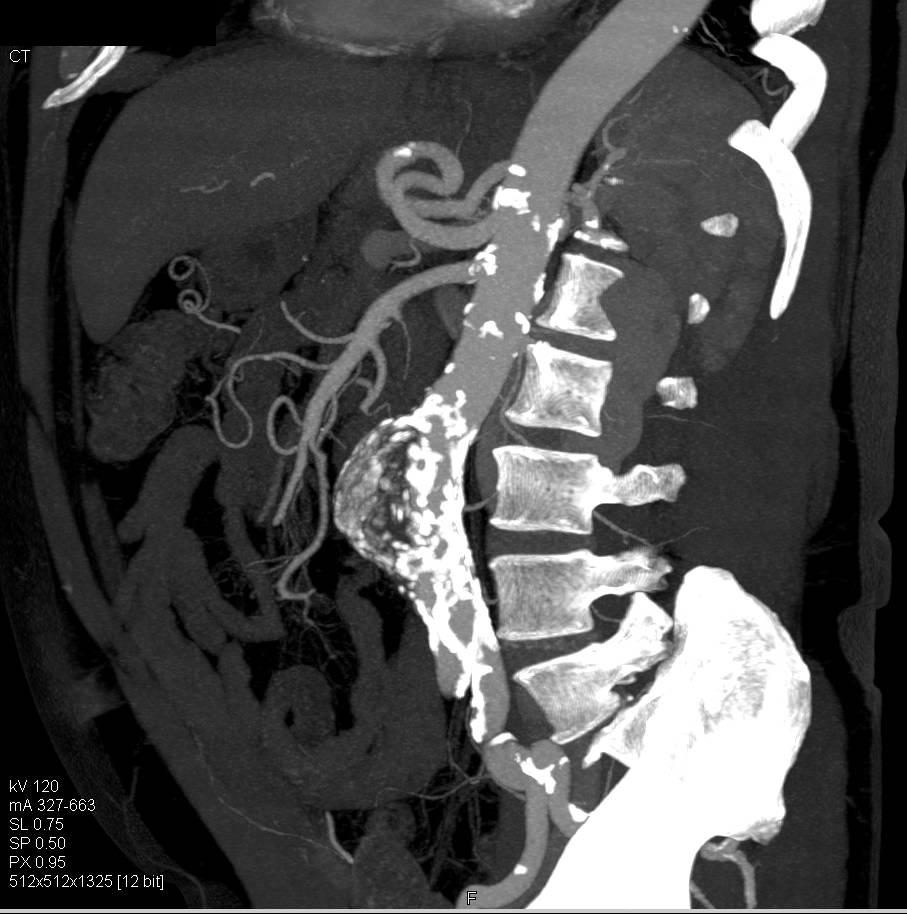 Chronic Pulmonary Embolism and Abdominal Aortic Aneurysm - CTisus CT Scan