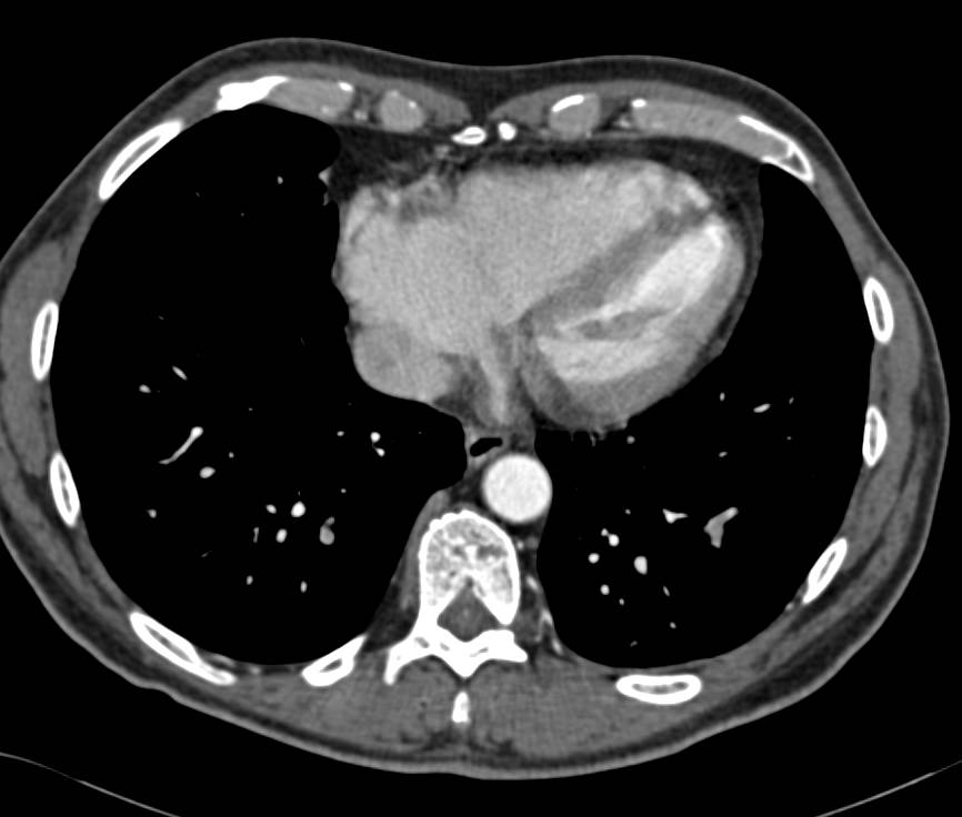 Incidental Pulmonary Embolism in a Patient With Pancreatic Cancer - CTisus CT Scan
