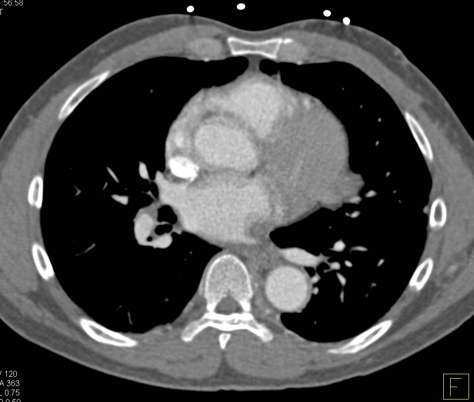 Implants on Pleural and Pericardial Surfaces due to Metastases - CTisus CT Scan
