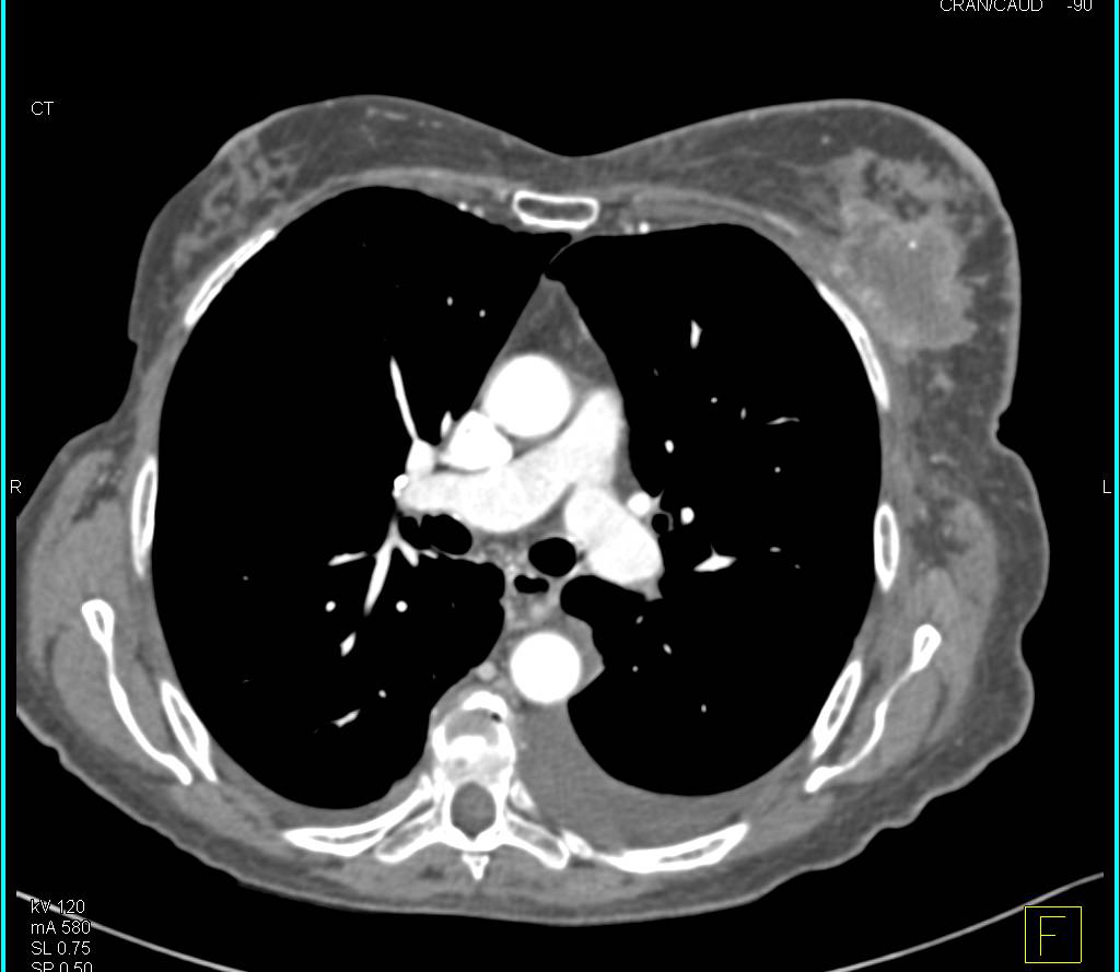 Left Breast Cancer with Carcinomatosis - CTisus CT Scan