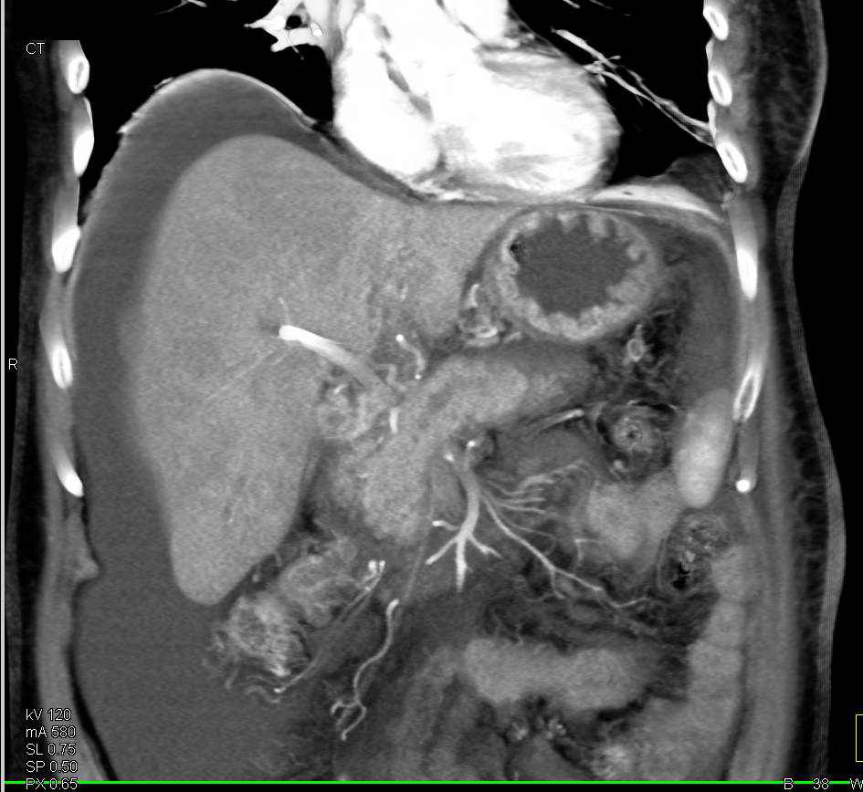 Left Breast Cancer with Tumor in Porta-Hepatis - CTisus CT Scan