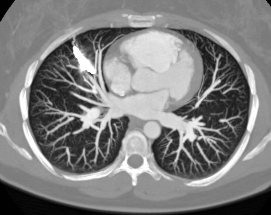 Pulmonary Arteriovenous Malformation (PAVM) with Embolization - Chest ...