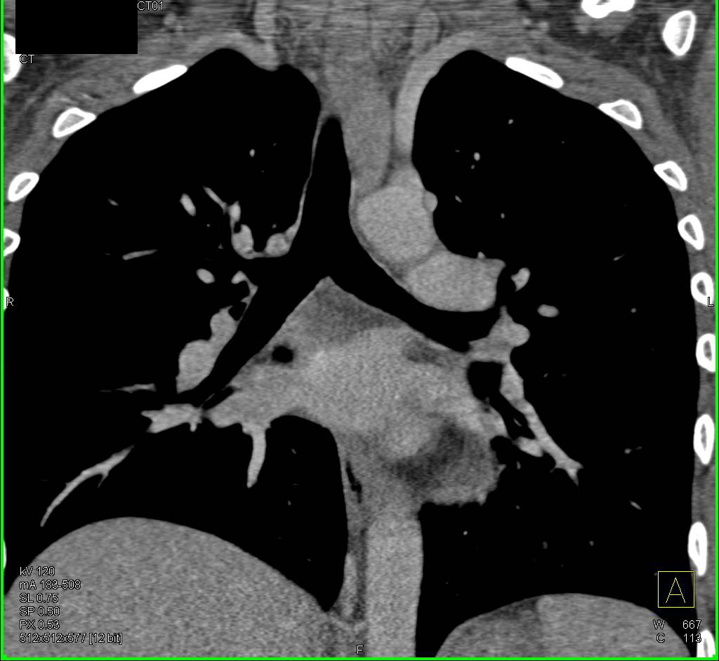 Ectopic Parathyroid Adenoma to Left of Trachea - CTisus CT Scan