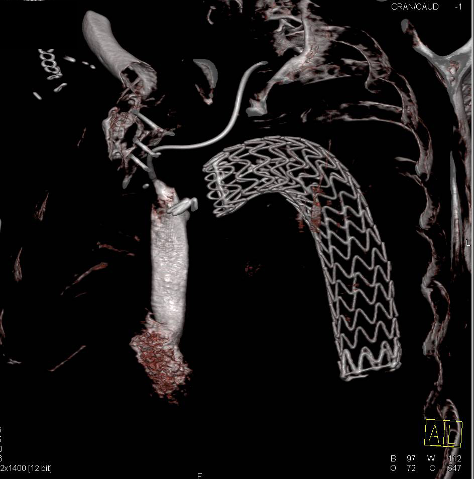 Endovascular Stent repair with Occlusion of Left Subclavian Artery and Clot in Left Jugular Vein - CTisus CT Scan