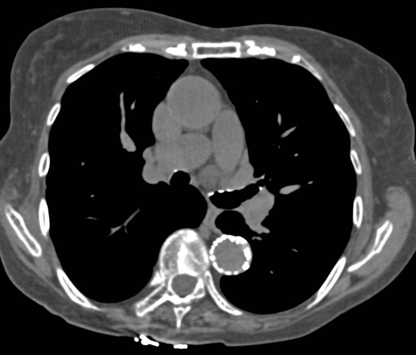 Descending Thoracic Aneurysm Repair with Endovascular Stent - CTisus CT Scan