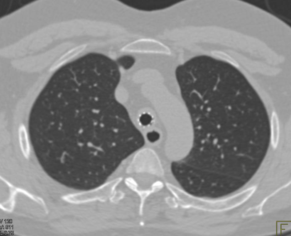 Tracheal Stenosis with Stent in Place - CTisus CT Scan