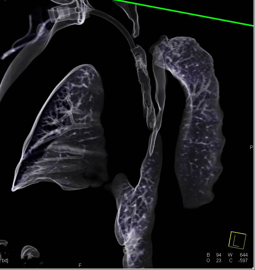 Thickening Airway with Stent in Airway - CTisus CT Scan