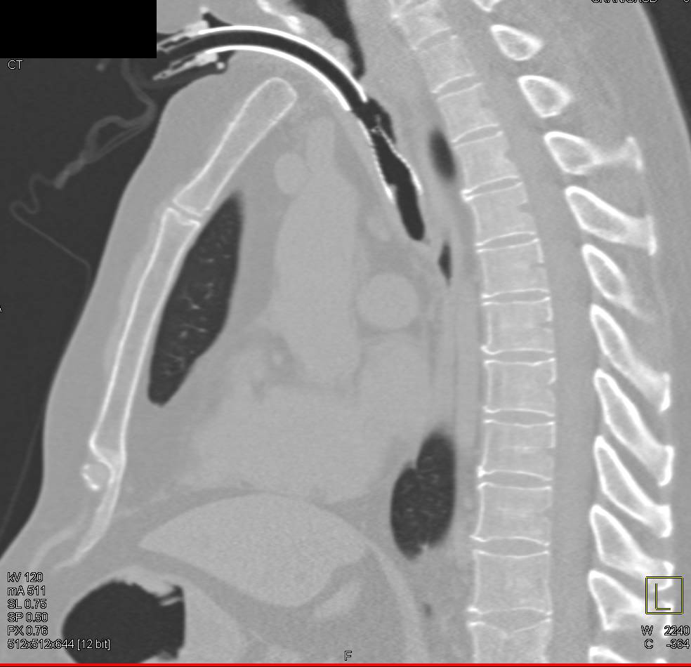 Endotracheal Tube and Tracheal and Main Bronchi Stents - CTisus CT Scan