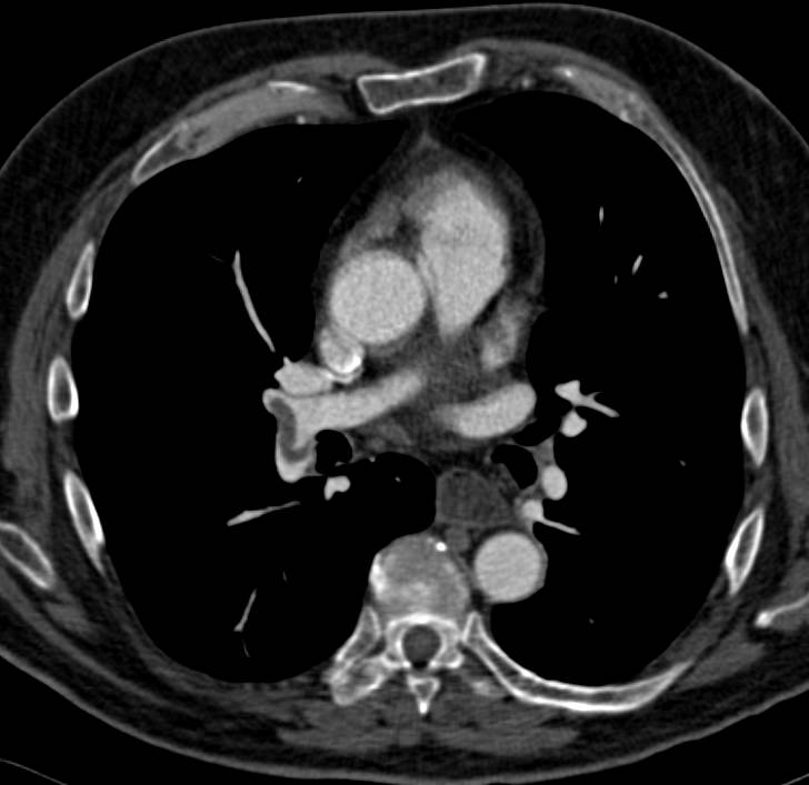 Pulmonary Embolism in patient s/p MVA - CTisus CT Scan