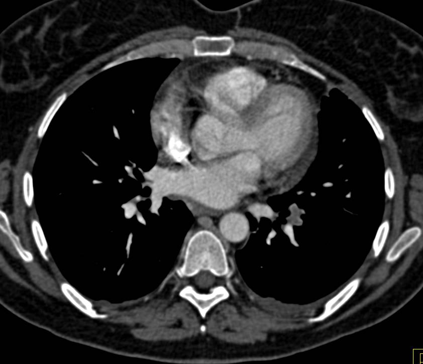 Incidental Pulmonary Embolism in Oncology Patient - CTisus CT Scan