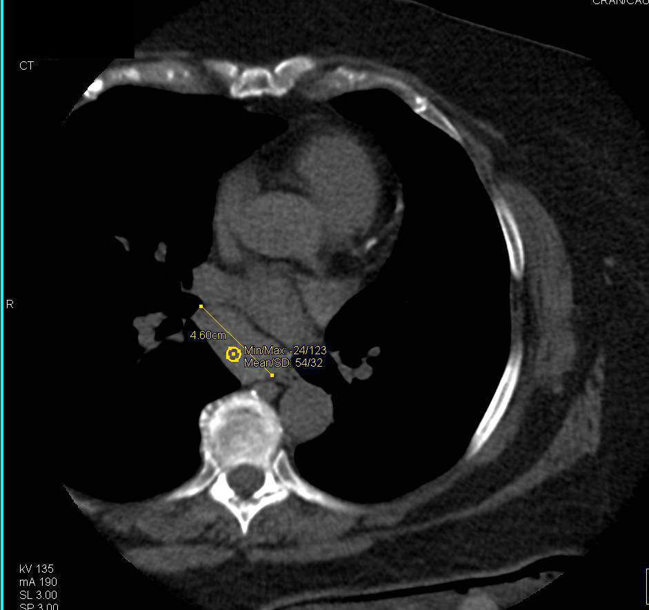 Subcarinal nodes - Chest Case Studies - CTisus CT Scanning