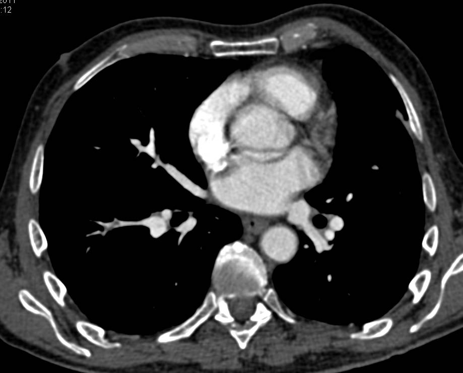 Incidental Pulmonary Embolism in a Patient With Pancreatic Cancer - CTisus CT Scan