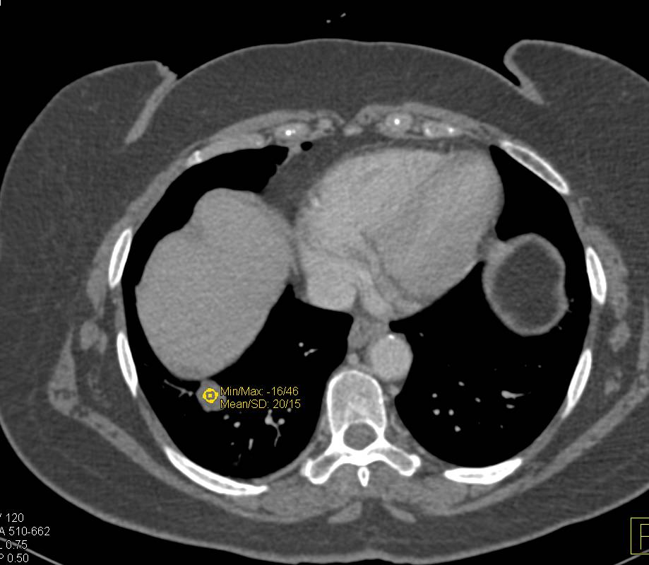 Hamartoma Right Lower Lung - CTisus CT Scan