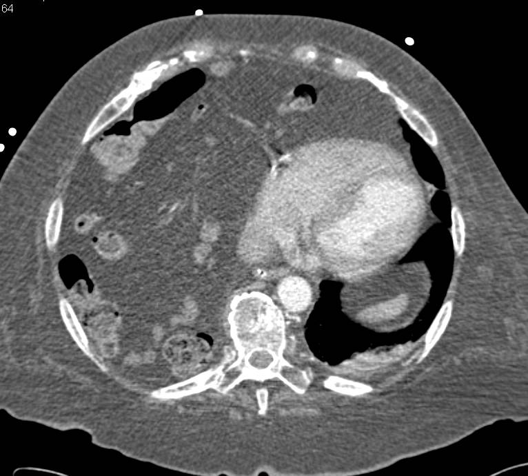 Ruptured Right Hemidiaphragm with Herniation of Bowel Above Liver - CTisus CT Scan