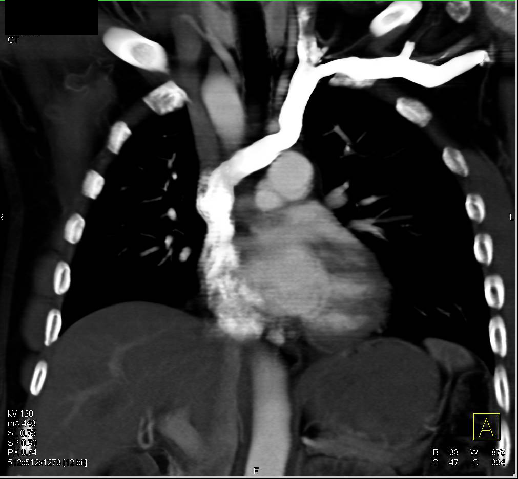 Unusual Posterior Course of Left Innominate Vein to Left Side of the Heart - CTisus CT Scan