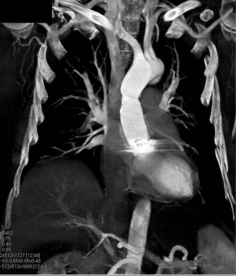 Composite Graft with Aortic Valve Replacement (AVR) - CTisus CT Scan