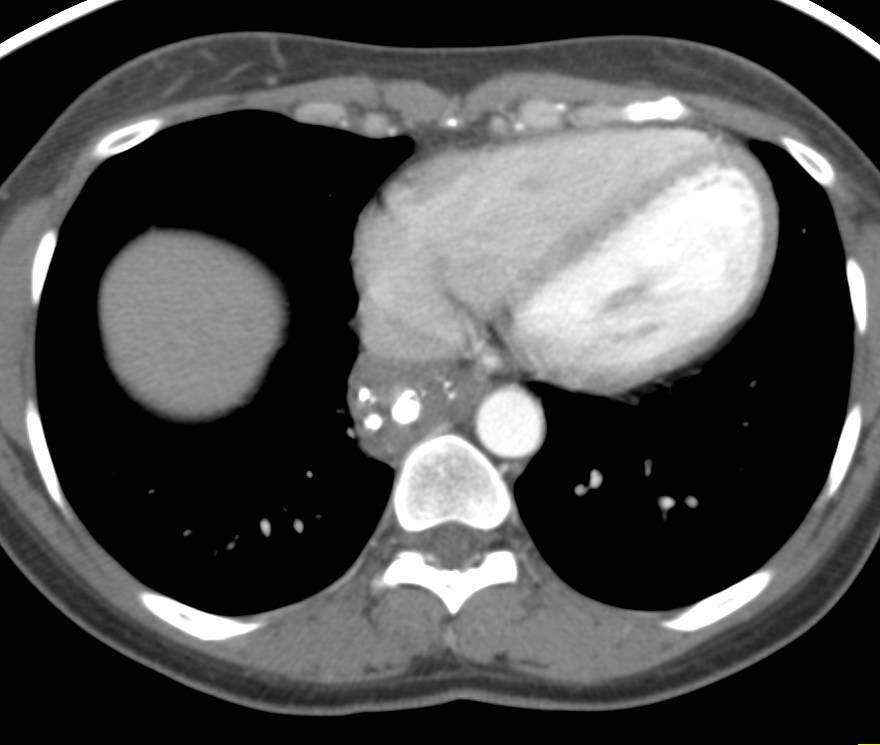 Posterior Mediastinal Mass was Neuroendocrine Tumor - CTisus CT Scan