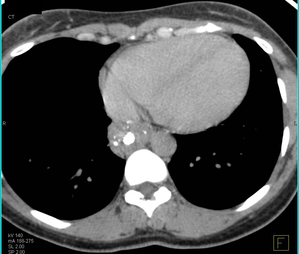 Mediastinal Teratoma - CTisus CT Scan