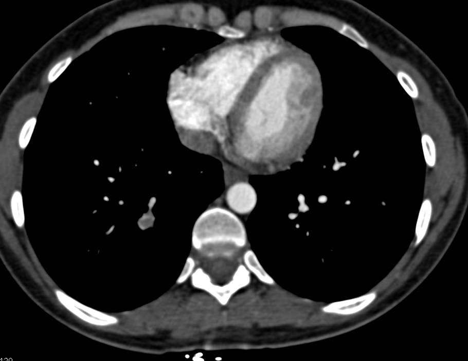 Pulmonary Embolism and Left Deep Vein Thrombosis (DVT) - CTisus CT Scan