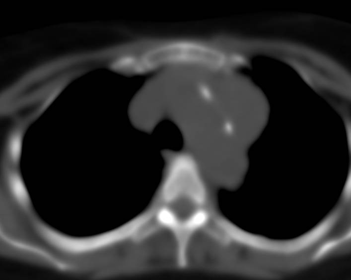 Thymoma - CTisus CT Scan