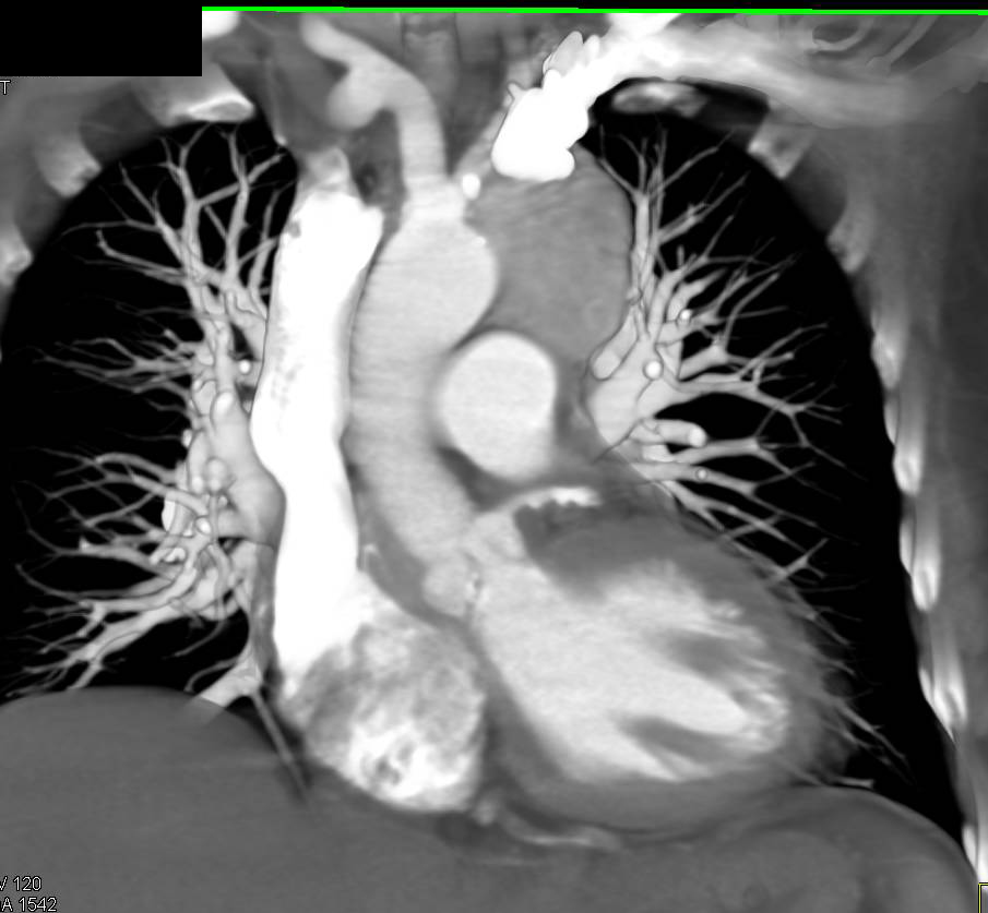 Thymoma - CTisus CT Scan