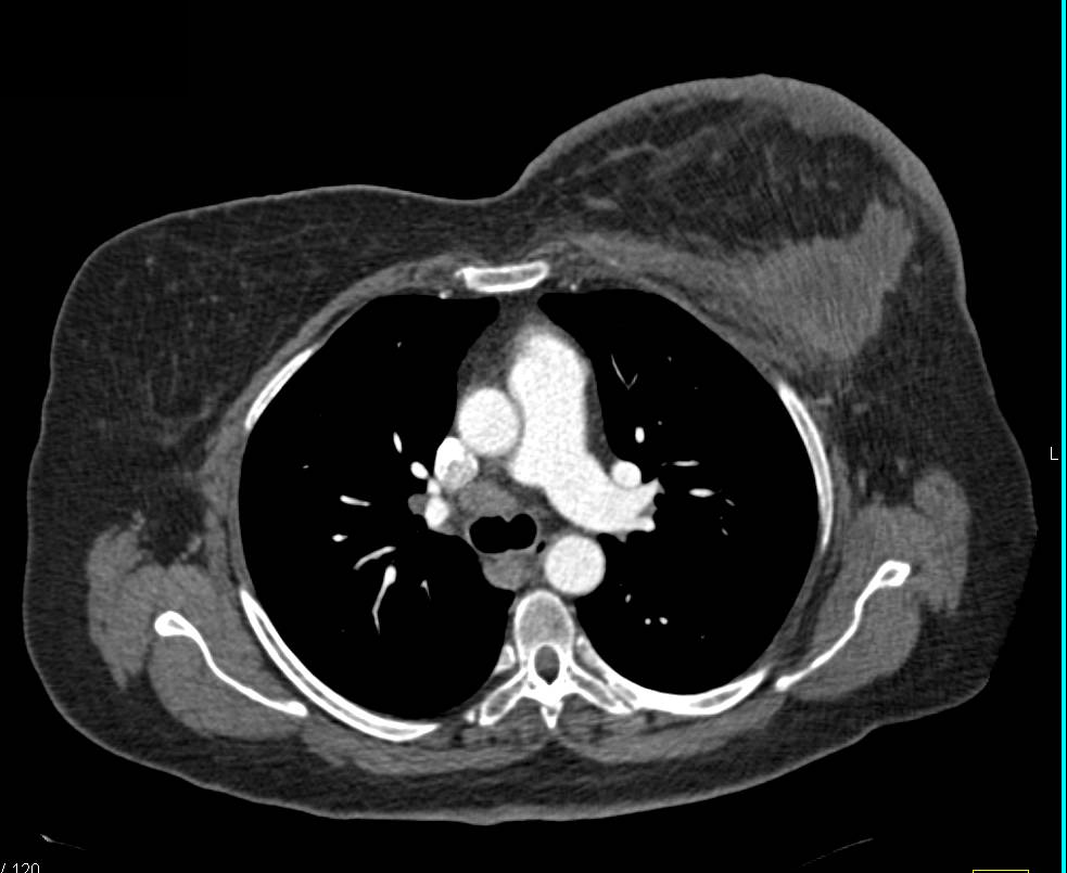 Infiltrating Carcinoma Left Breast with Axillary Adenopathy - CTisus CT Scan