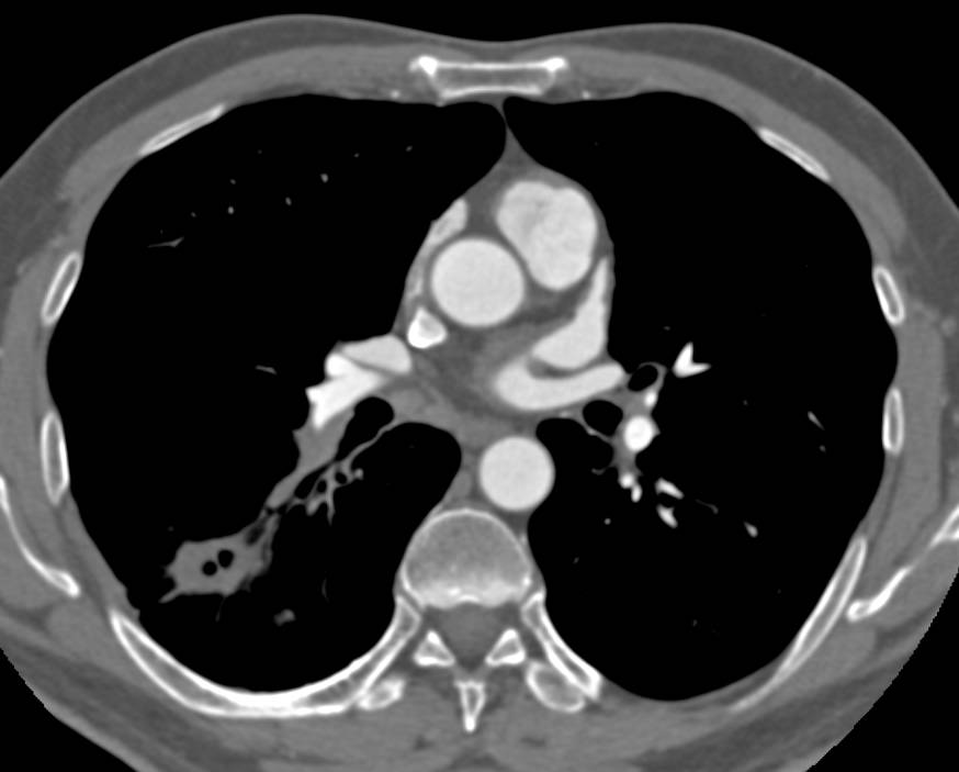 BAC-Bronchoalveolar Cell Carcinoma - CTisus CT Scan