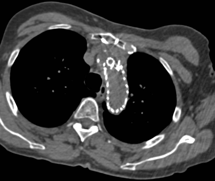 Endovascular Stent in Thoracic Aorta - CTisus CT Scan