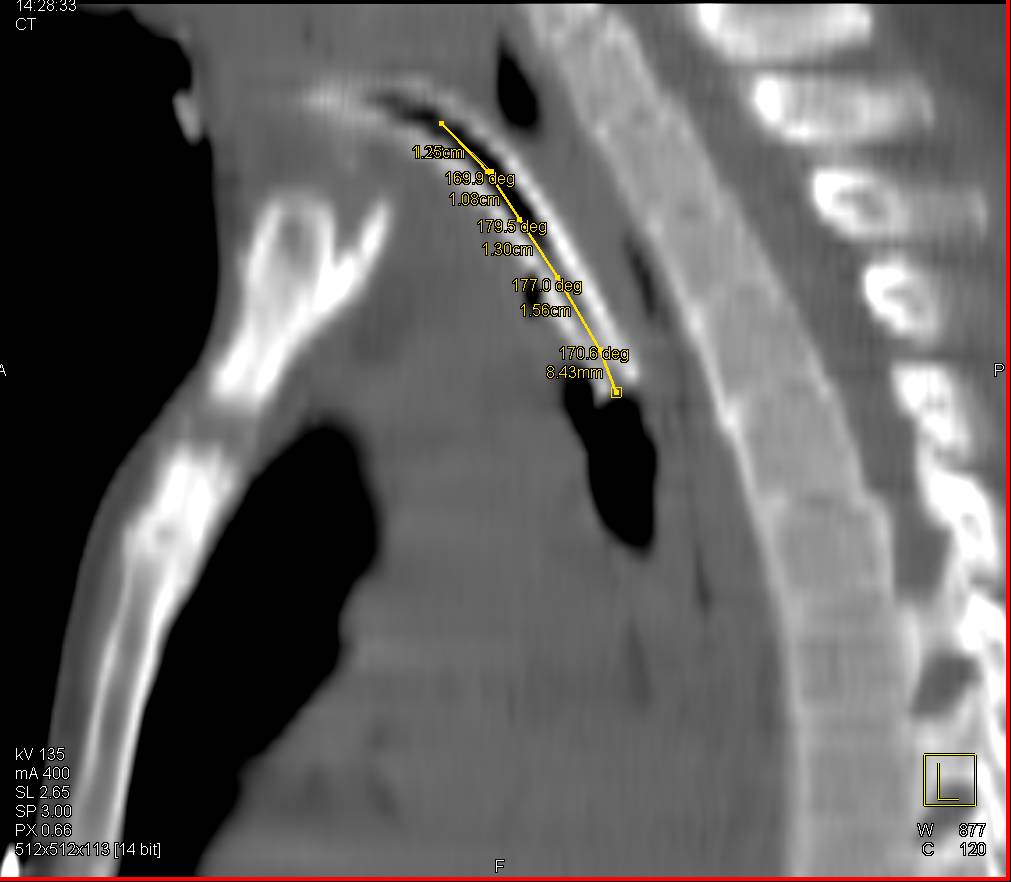 Tracheal Stent in a Child - CTisus CT Scan