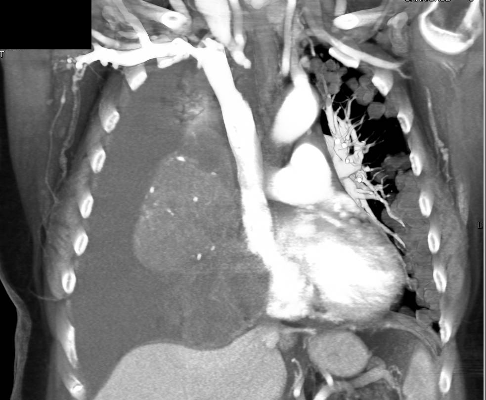 Small Cell Lung Cancer with Carcinomatosis - CTisus CT Scan