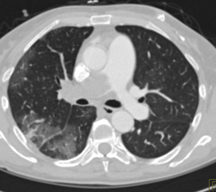 pulmonary embolism อาการ causes