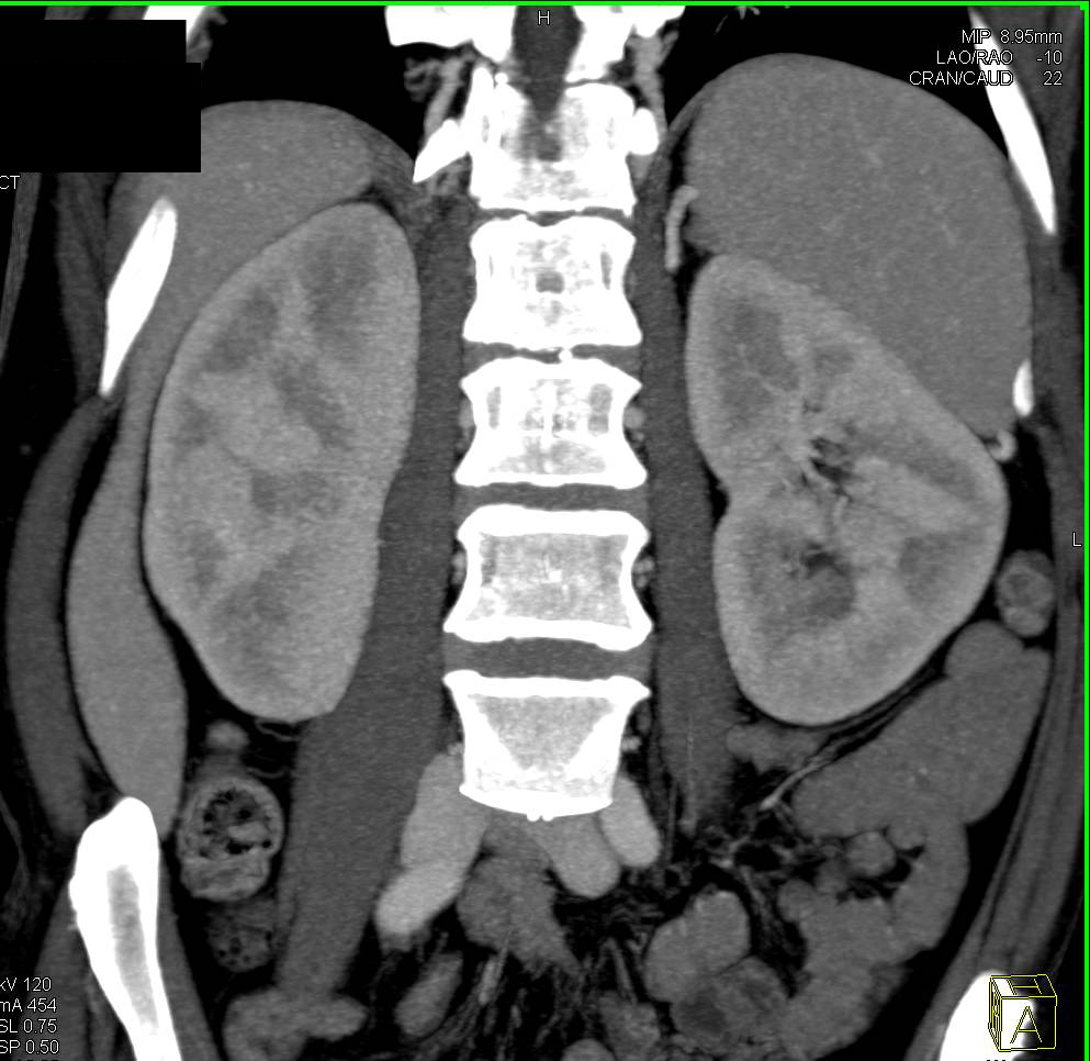 Multiple Pulmonary Emboli (PEs) with Splenic Infarct - CTisus CT Scan
