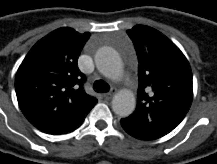 Normal Thymus for Age - CTisus CT Scan
