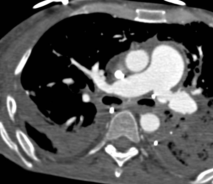 Encased Left Pulmonary Vein with Active Bleed - CTisus CT Scan