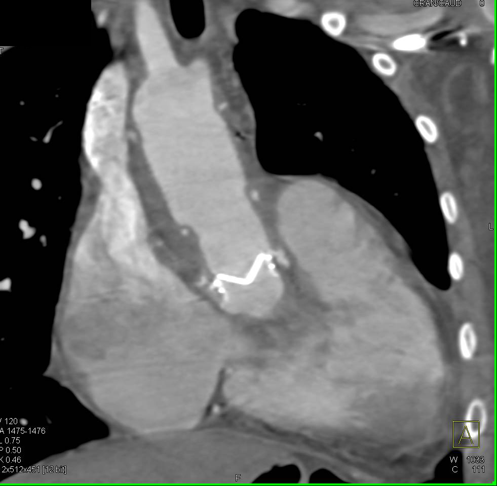 Aortic Valve and Root Repair - CTisus CT Scan