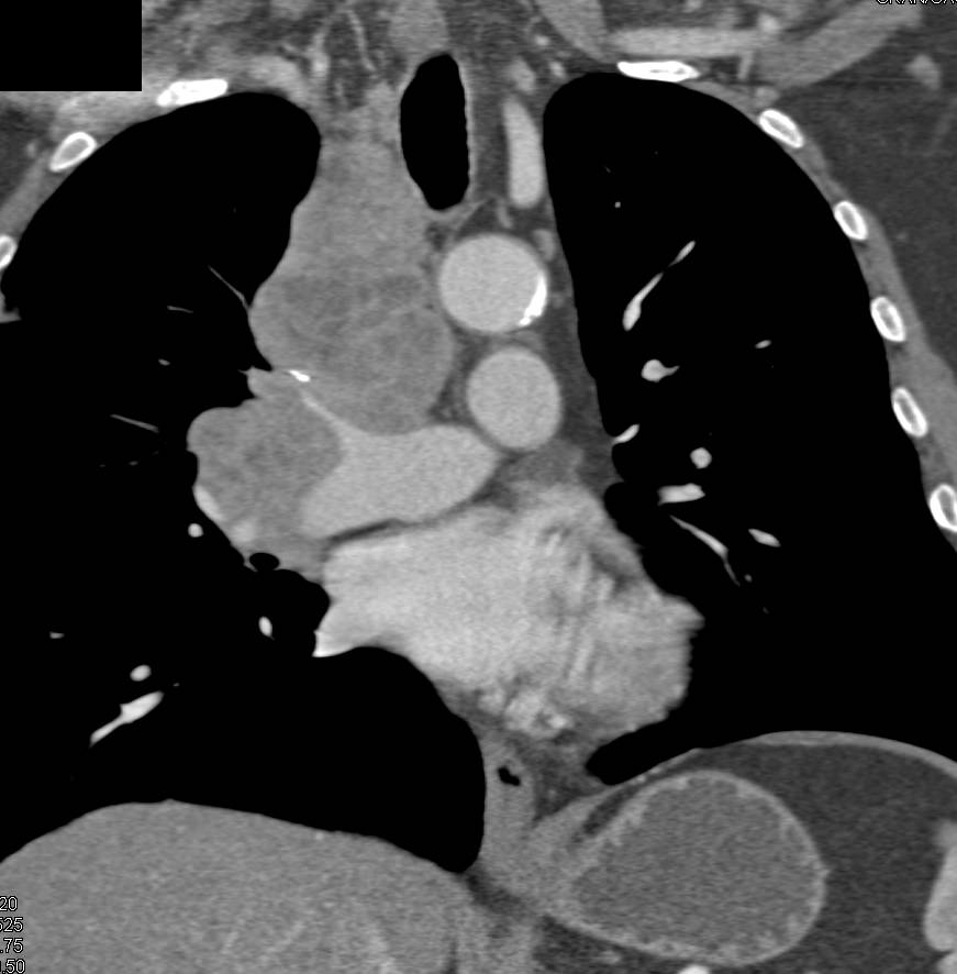 Small Cell Lung Cancer with Paratracheal Adenopathy - Chest Case