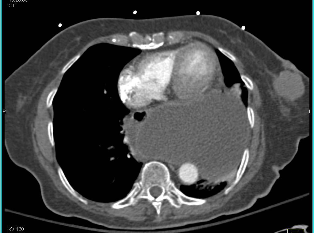 Incidental Left Breast Cancer in a Patient with a Paraesophageal Hiatal Hernia - CTisus CT Scan