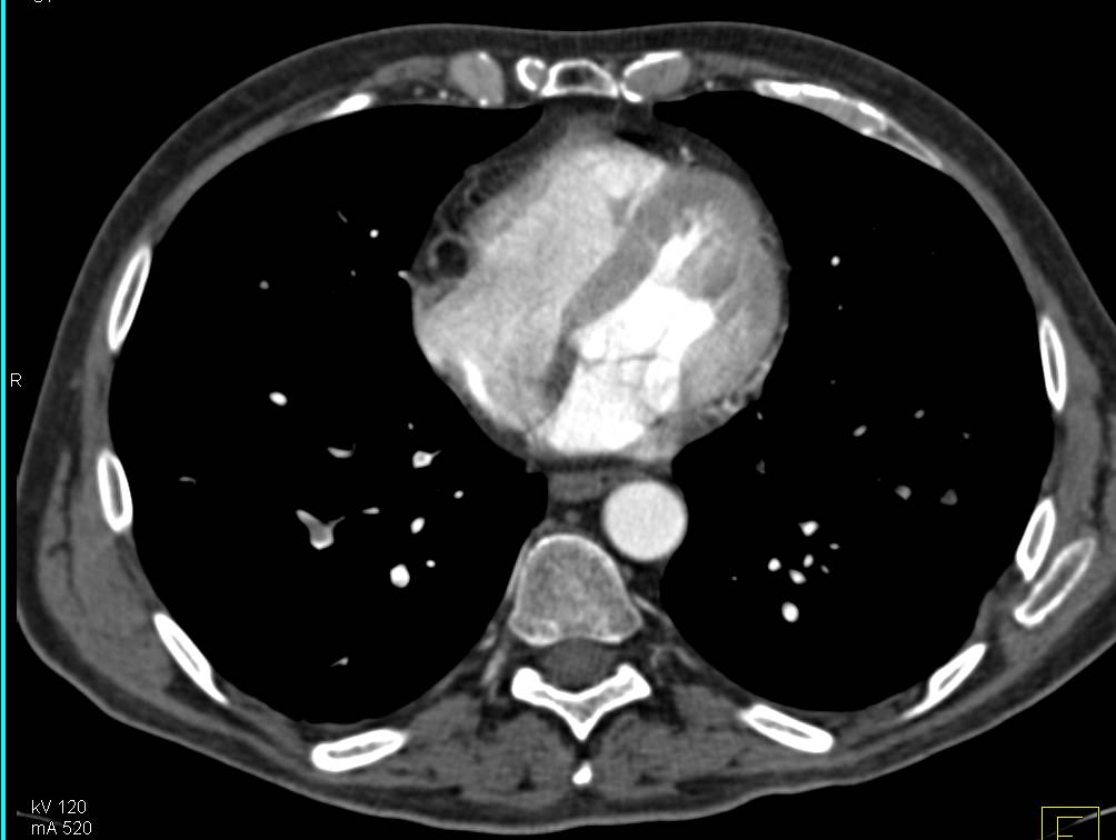 Incidental Pulmonary Embolism (PE) in a Patient wit Pancreatic Cancer - CTisus CT Scan