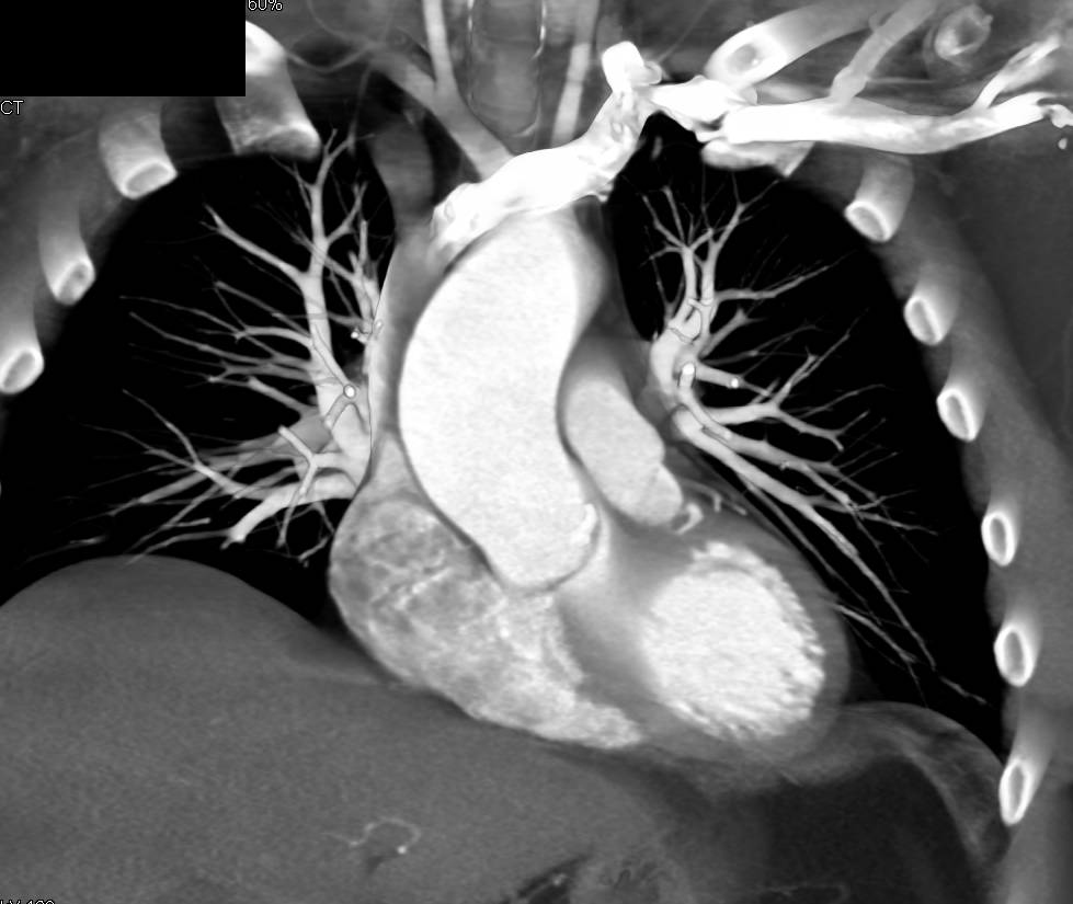 Dilated Aortic Root - CTisus CT Scan