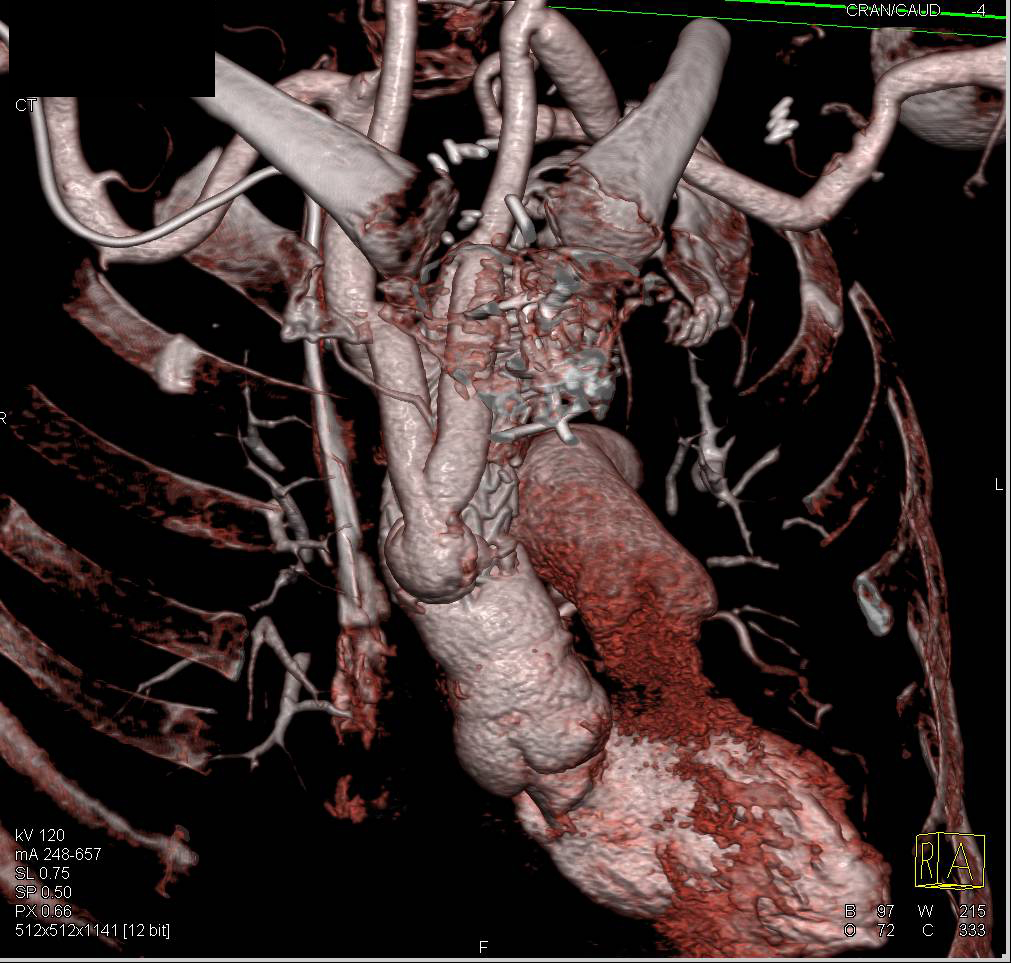 Arch Repair with Reimplantation of Great Vessels - CTisus CT Scan