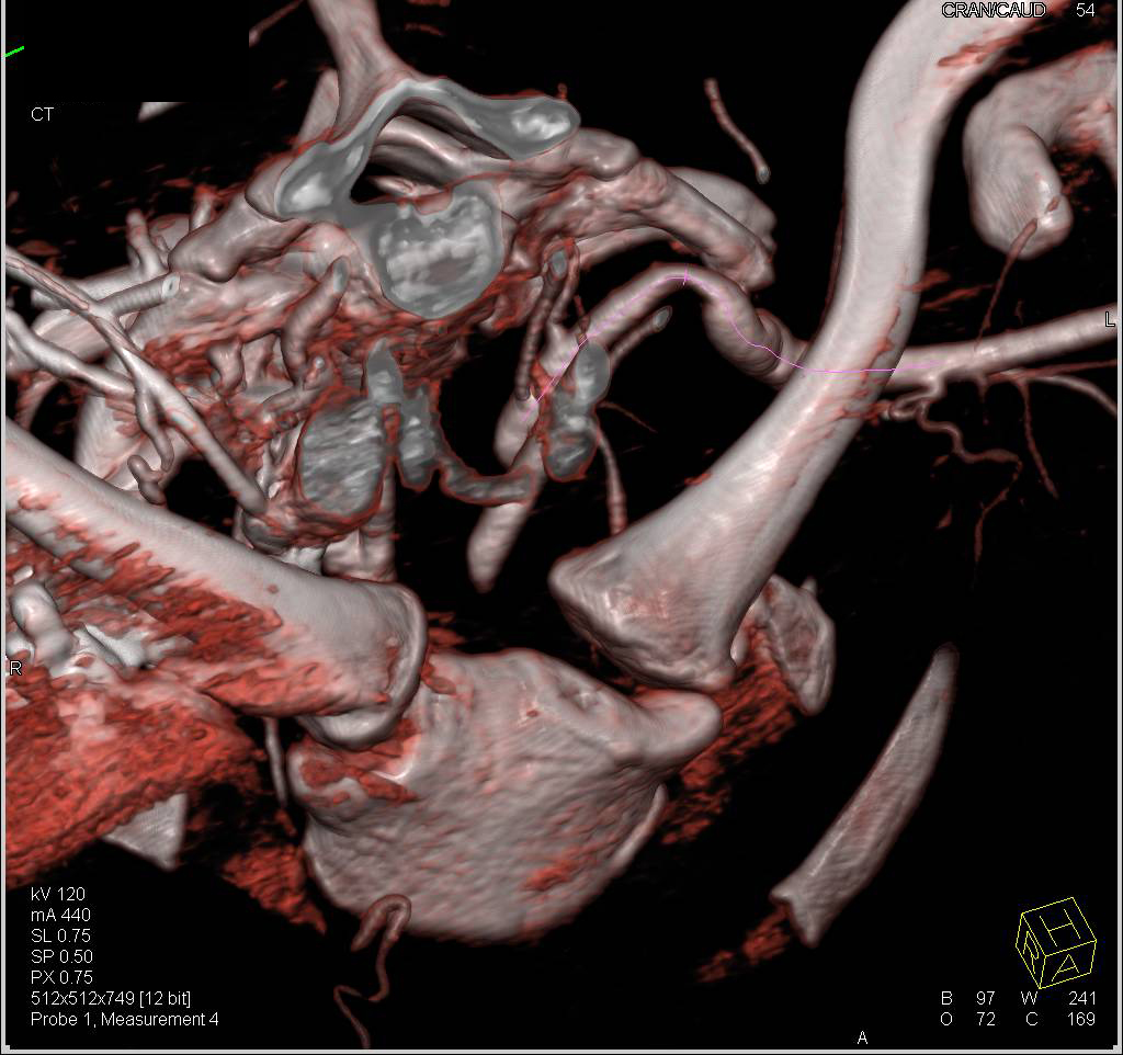 Thoracic Outlet Obstruction Symptoms with Kinked Left Subclavian Artery in 2 Positions - CTisus CT Scan