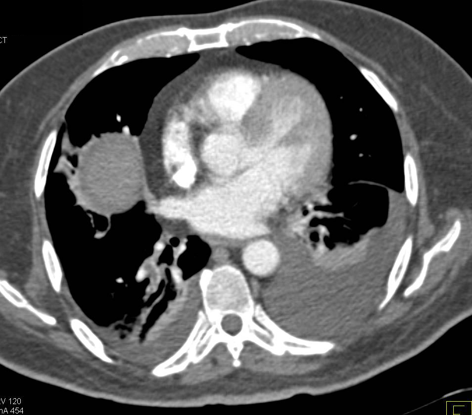 Pulmonary Embolism - CTisus CT Scan