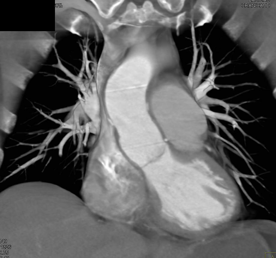 CTA of Aortic Root Repair - CTisus CT Scan