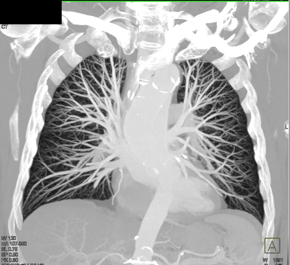 MIP Imaging of Normal Pulmonary Vasculature - CTisus CT Scan