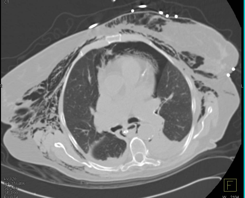 Pneumomediastinum and Extensive Subcutaneous Air - CTisus CT Scan