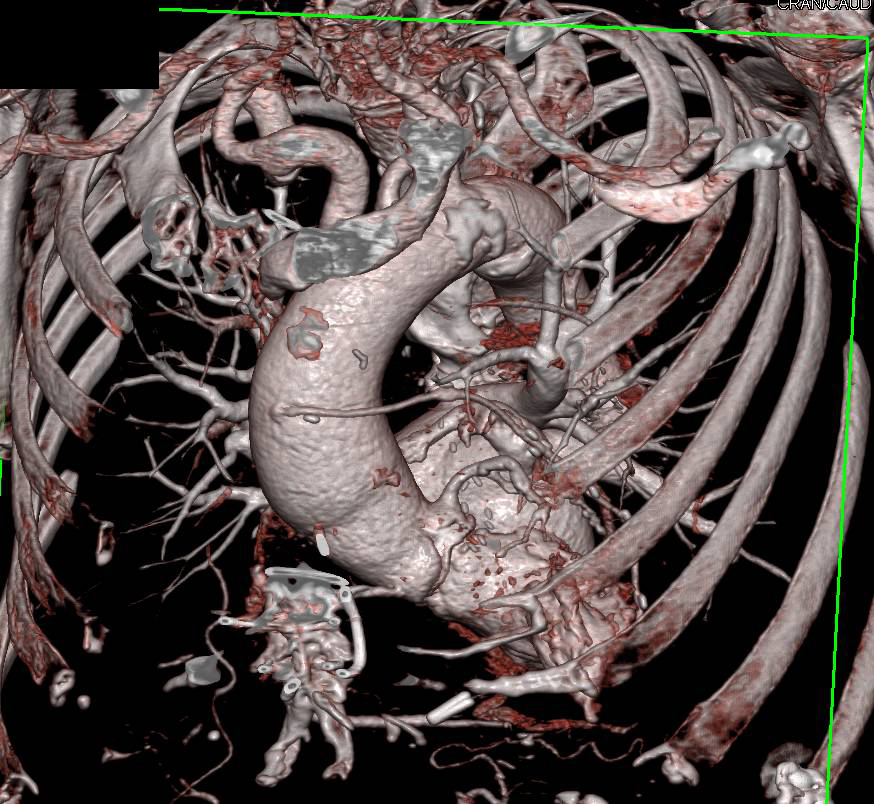 Prior Aortic Surgery With Aortic Valve Replacement (AVR) and Coronary Artery Bypass Graft (CABG) Without Complication - CTisus CT Scan